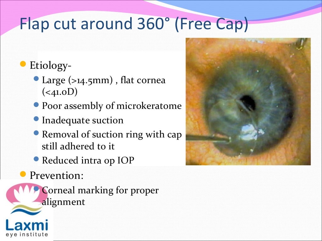 LASIK COMPLICATIONS AND THEIR MANAGEMENT