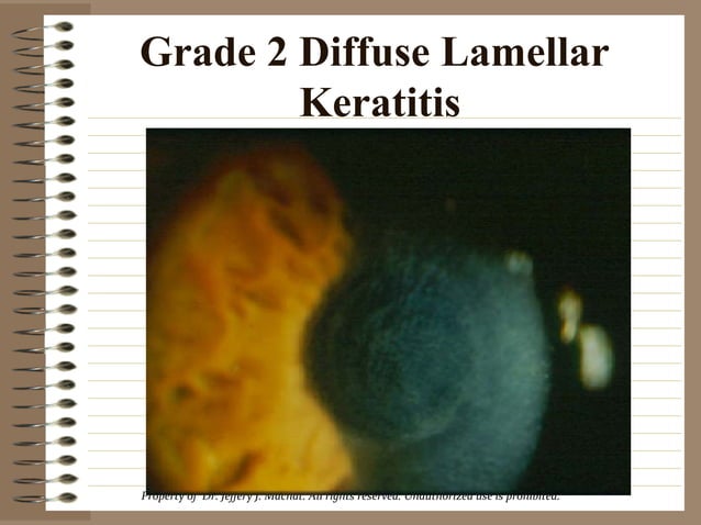 Lasik Complications 2001 Diffuse Lamellar Keratitis by Dr. Jeffery ...