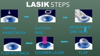 LASIK REFRACTIVE SURGERY DEMYSTIFIED | PPTX