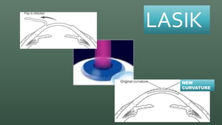 LASIK REFRACTIVE SURGERY DEMYSTIFIED | PPTX