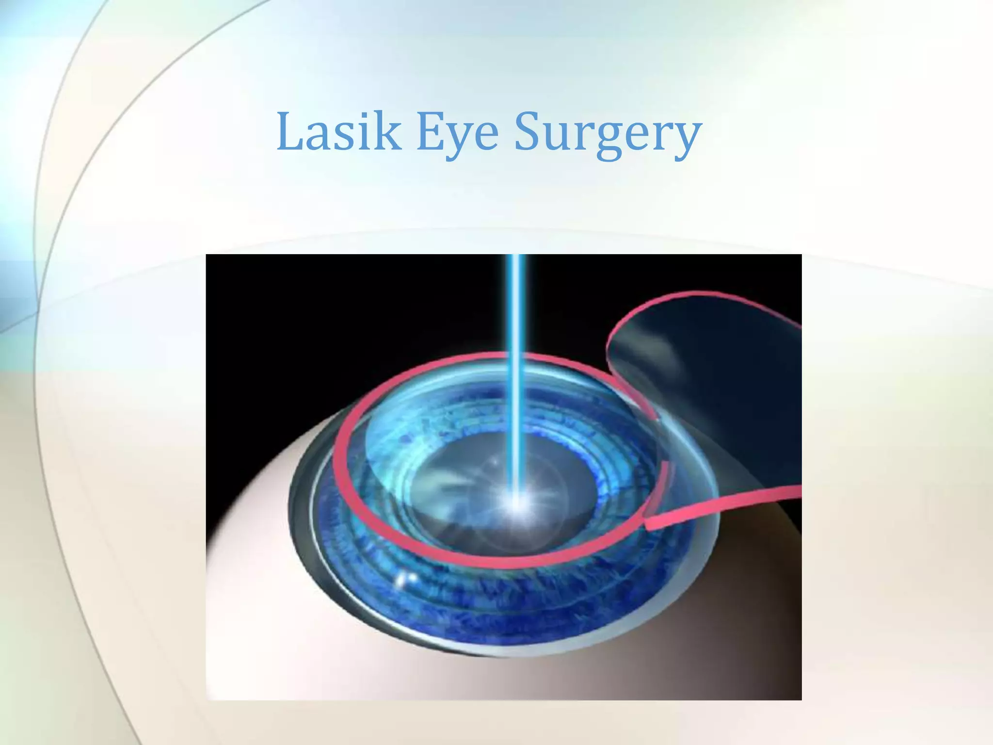 Vibrant What Is Lasik Eye Surgery Picture Illustration Vibrant What Is Lasik Eye Surgery Picture Illustration