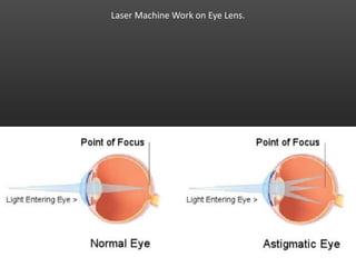 Laser Machine Work on Eye Lens.
 