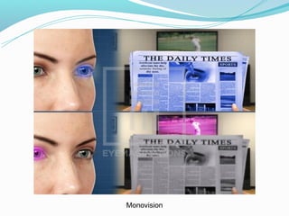 Monovision
 