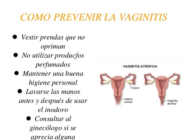 Resultado de imagen para prevenir vaginitis
