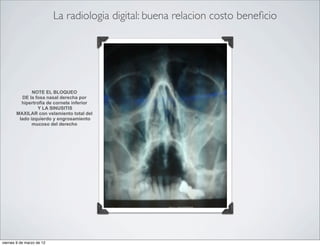 La sinusitis | PDF