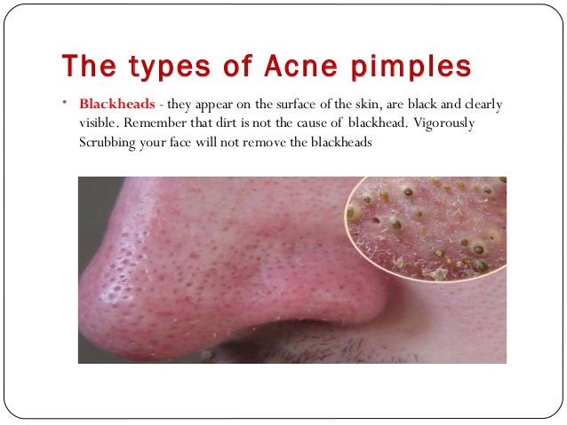 Laser Hair Removal Treatments In India