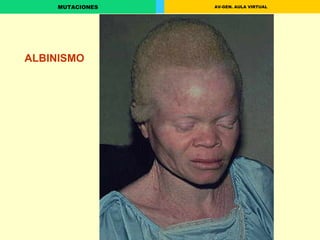 ALBINISMO 