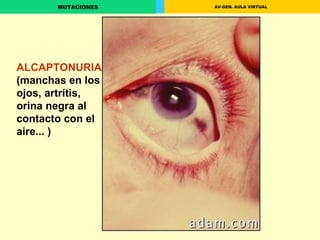 ALCAPTONURIA  (manchas en los ojos, artrítis, orina negra al contacto con el aire... ) 