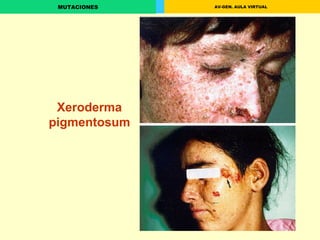 Xeroderma pigmentosum 