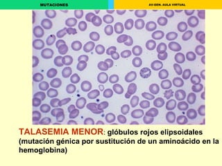 TALASEMIA MENOR :  glóbulos rojos elipsoidales (mutación génica por sustitución de un aminoácido en la hemoglobina) 