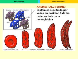 ANEMIA FALCIFORME:  Glutámico sustituido por valina en posición 6 de las cadenas beta de la hemoglobina 