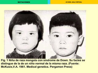 Fig. 1 Niña de raza mongola con síndrome de Down. Su facies se distingue de la de un niño normal de la misma raza. (Fuente: McKusix,V.A. 1961. Medical genetics. Pergamon Press)                                                                                                                                                                                                                                                                               