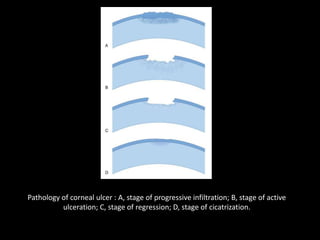 Pathology of corneal ulcer : A, stage of progressive infiltration; B, stage of active
ulceration; C, stage of regression; D, stage of cicatrization.

 