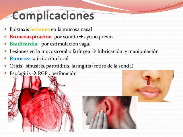 La sonda nasogastrica