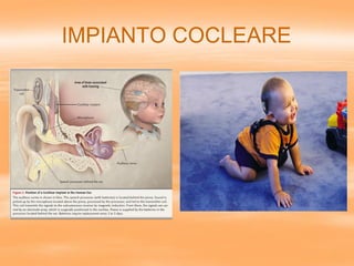 IMPIANTO COCLEARE
 