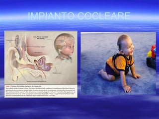 IMPIANTO COCLEARE

 
