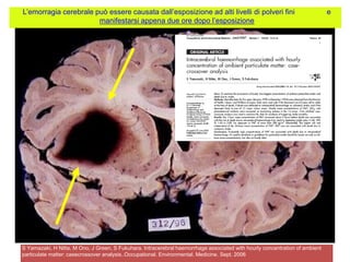 L‟emorragia cerebrale può essere causata dall‟esposizione ad alti livelli di polveri fini e
manifestarsi appena due ore dopo l‟esposizione
S Yamazaki, H Nitta, M Ono, J Green, S Fukuhara. Intracerebral haemorrhage associated with hourly concentration of ambient
particulate matter: casecrossover analysis..Occupational. Environmental. Medicine. Sept. 2006
 