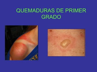 QUEMADURAS DE PRIMER
      GRADO
 