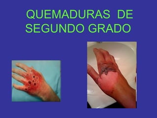 QUEMADURAS DE
SEGUNDO GRADO
 