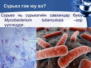 сүрьеэ өвчин | PPT
