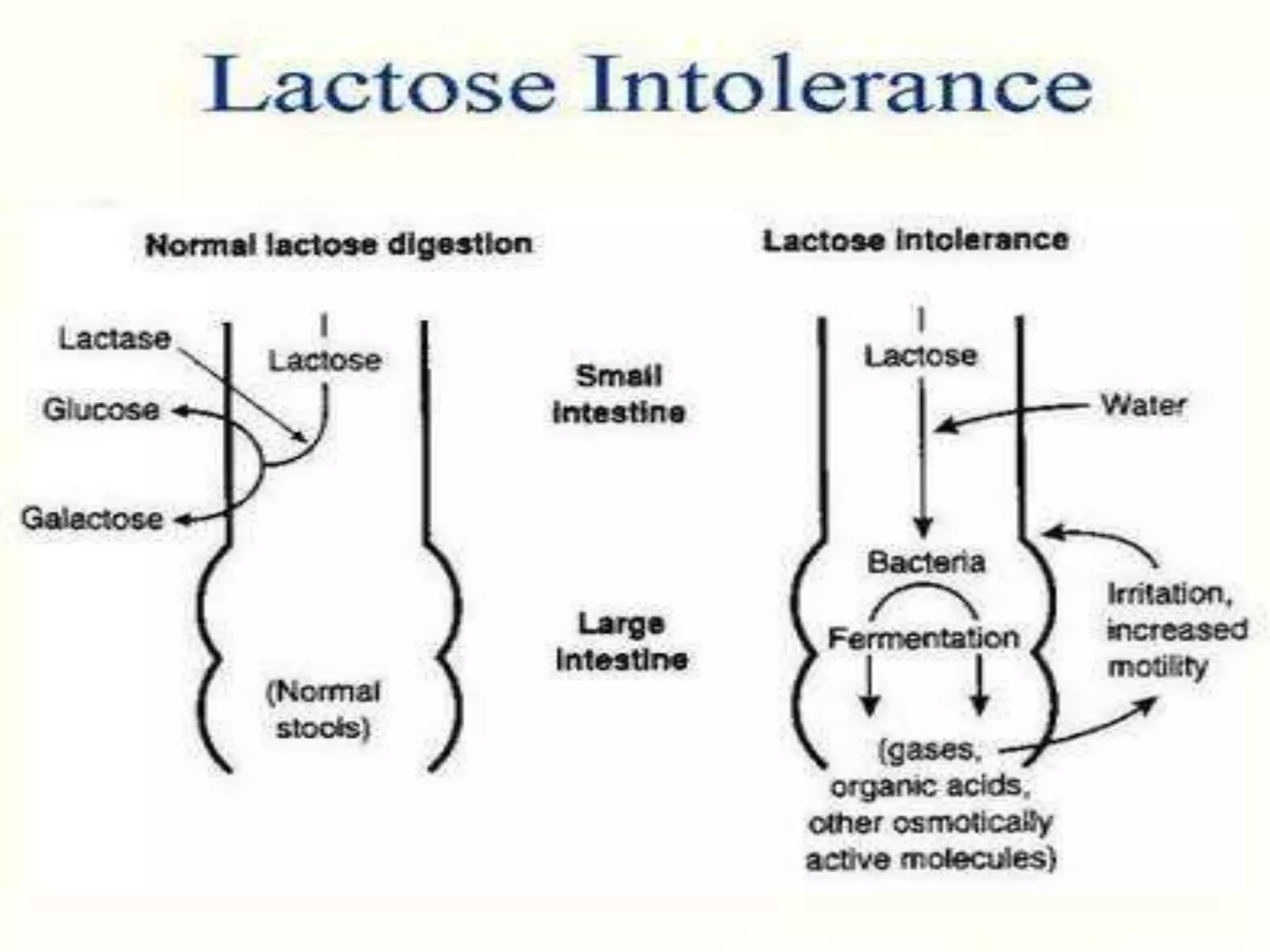 Lactose Und Fructoseintoleranz