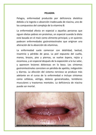 PELAGRA
Pelagra, enfermedad producida por deficiencia dietética
debida a la ingesta o absorción inadecuada de niacina, uno de
los compuestos del complejo de la vitamina B.
La enfermedad afecta en especial a aquellas personas que
siguen dietas pobres en proteínas, en especial cuando la dieta
está basada en el maíz como alimento principal, y en quienes
padecen enfermedades gastrointestinales que originan una
alteración de la absorción de vitaminas.
La enfermedad suele comenzar con debilidad, laxitud,
insomnio y pérdida de peso. La piel expuesta del cuello,
manos, brazos, pies y piernas, se vuelve áspera, rojiza y
escamosa, y en especial después de la exposición a la luz solar,
y aparecen lesiones dolorosas en la boca. Los síntomas
gastrointestinales consisten en pérdida de apetito, indigestión
y diarrea. La afección del sistema nervioso se produce más
adelante en el curso de la enfermedad e incluye síntomas
como cefaleas, vértigo, dolores generalizados, temblores
musculares y trastornos mentales. La deficiencia de niacina
puede ser mortal.

 