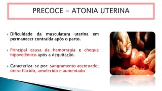  Dificuldade da musculatura uterina em
permanecer contraída após o parto.
 Principal causa da hemorragia e choque
hipovolêmico após a dequitação.
 Caracteriza-se por: sangramento acentuado;
útero flácido, amolecido e aumentado
 