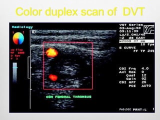 Color duplex scan of DVT
 