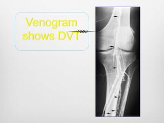 Venogram
shows DVT
 