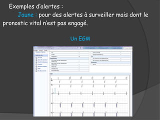 Exemples d’alertes :
Jaune : pour des alertes à surveiller mais dont le
pronostic vital n’est pas engagé.
Un EGM
 