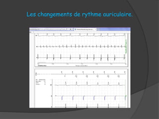 Les changements de rythme auriculaire.
 