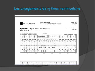 Les changements de rythme ventriculaire
 