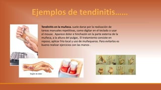 Tendinitis en la muñeca. suele darse por la realización de
tareas manuales repetitivas, como digitar en el teclado o usar
el mouse. Aparece dolor e hinchazón en la parte externa de la
muñeca, a la altura del pulgar,. El tratamiento consiste en
reposo, aplicar frío local y uso de muñequeras. Para evitarlos es
bueno realizar ejercicios con las manos .
 
