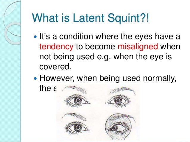 Latent squint or (heterophoria)