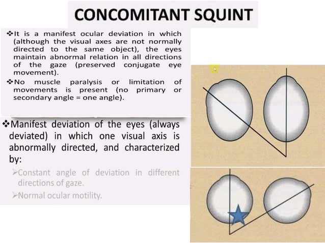 Concommitant Latent and concomitant strabismus | PPT