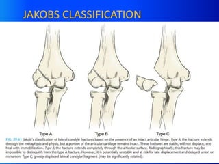 Lateral condyle.pptx