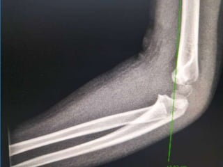 Raidal Condyle Lateral condyle.pptx