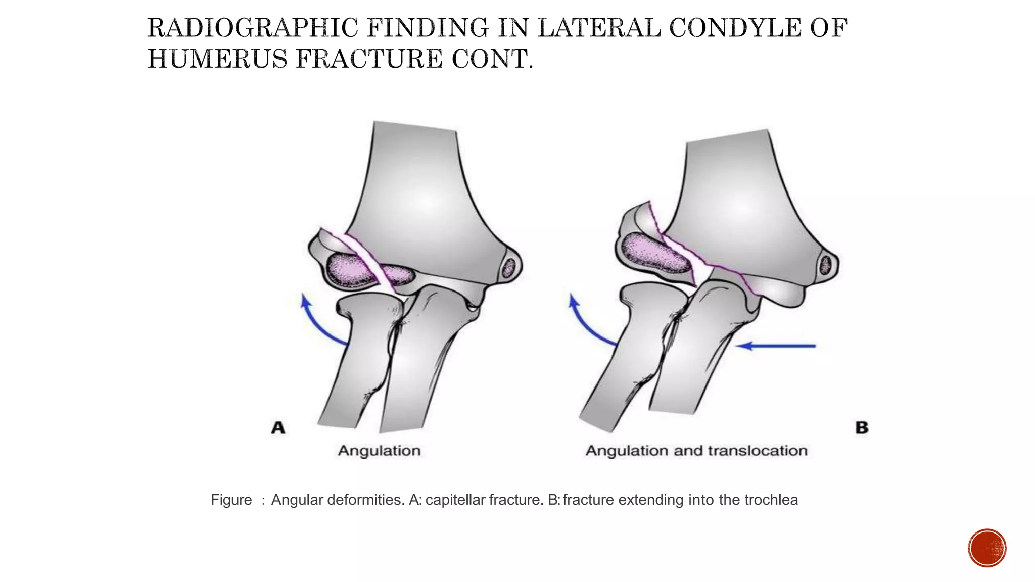 Lateral condyle fracture of humerus in children | PPTX