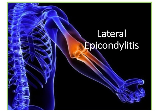 肘外側上顆炎 テニス肘 治療など文献まとめ Lateral Epicondylitis