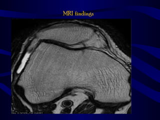 MRI findings
 