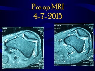Pre op MRI
4-7-2015
 
