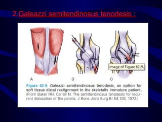 2.Galeazzi semitendinosus tenodesis :
 