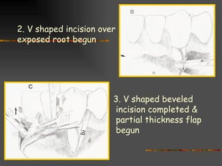 Lateral pedical graft | PPT