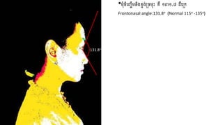 •មុំចិញ្ចើមនិងខ្ទង់ច្ចមុះ គឺ ១៣១.៨ ដឺញច្េ
Frontonasal angle:131.8o (Normal 115o -135o)
131.8o
 