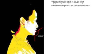 •មុំបបូរមាត់ញច្ោមនិងចង្កា រគឺ ១២០.៤៦ ដឺញច្េ
Labiomental angle:120.46o (Normal 114o -140o)
120.46o
 