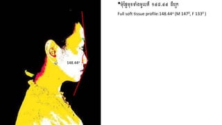 •មុំផ្ទទមខ្ទុំងមូ គឺ ១៤៨.៤៤ ដឺញច្េ
Full soft tissue profile:148.44o (M 1470, F 1330 )
148.44o
 