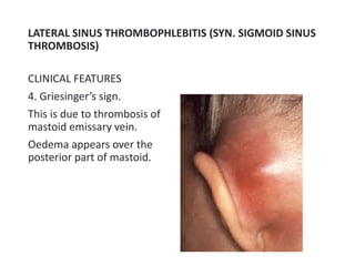 Complication of CSOM - Lateral Sinus Thrombosis | PPTX