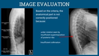 IMAGE EVALUATION
Based on the criteria, the
anatomical part is not
correctly positioned
because:
under rotation seen by
insufficient superimposition
of posterior ribs
Insufficient collimation
 