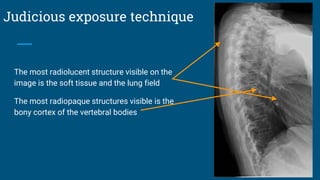 Judicious exposure technique
The most radiolucent structure visible on the
image is the soft tissue and the lung field
The most radiopaque structures visible is the
bony cortex of the vertebral bodies
 