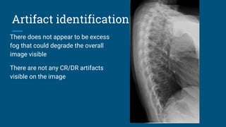 Artifact identification
There does not appear to be excess
fog that could degrade the overall
image visible
There are not any CR/DR artifacts
visible on the image
 